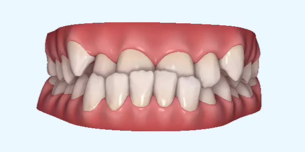 Underbite